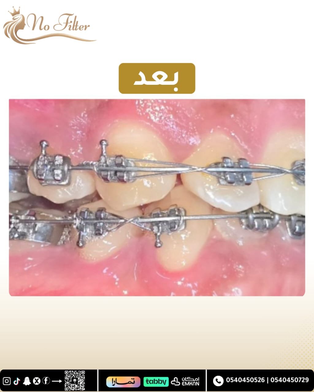 تقويم الاسنان