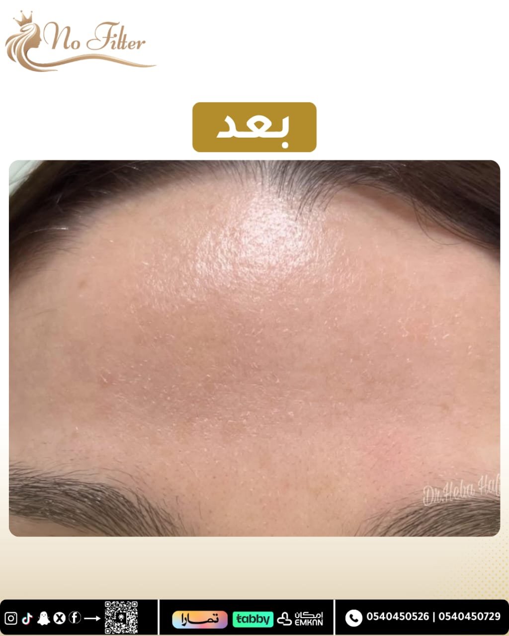 بوتوكس الجبهة