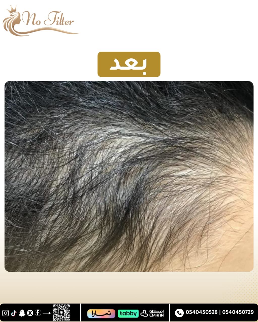 اكسوزوم للشعر