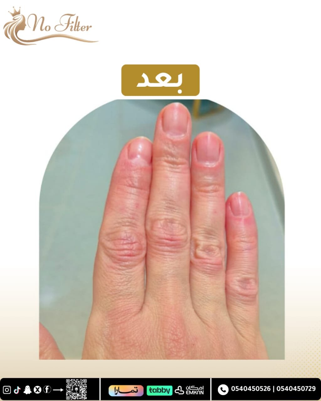 نضارة و امتلاء اليدين